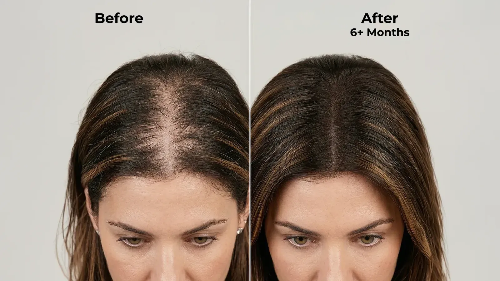 Ghori® Derma Roller banner on expected results when used consistently with Neo Hair Lotion Ghori® Derma Roller banner on expected results when used consistently with Neo Hair Lotion