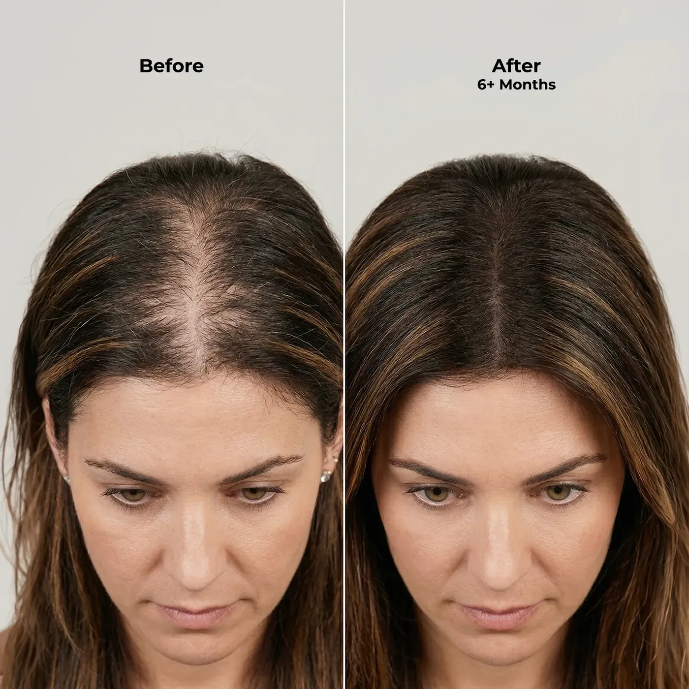 Ghori® Derma Roller in use on the scalp hairline, demonstrating rolling direction
